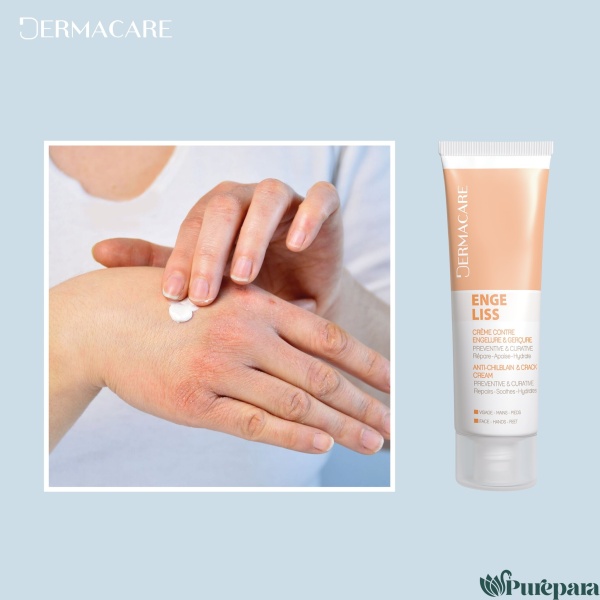 Dermacare Engeliss creme 50 ml